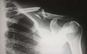 x-ray image of a broken collarbone