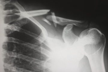 x-ray image of a broken collarbone